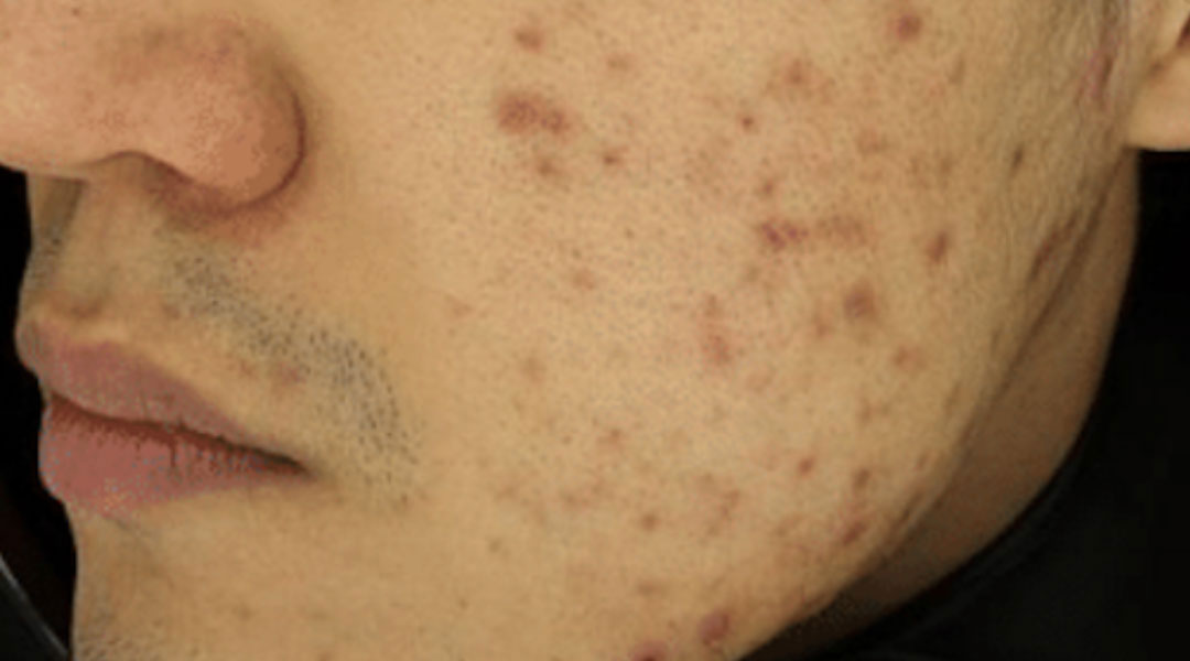 Aesthetics Skin Treatments Thread lift Tulsa