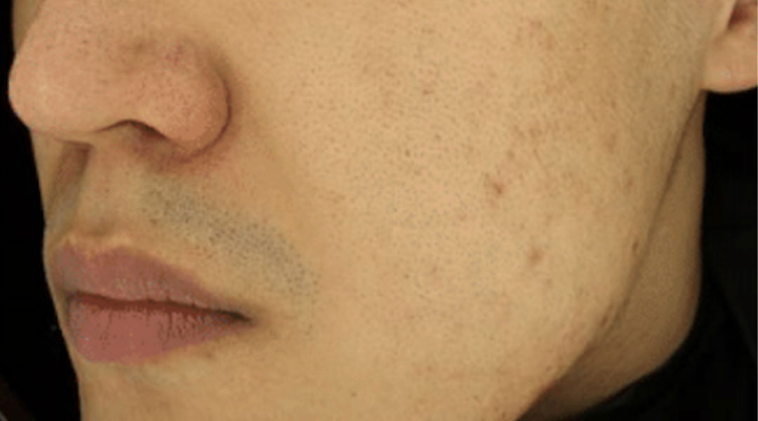 Aesthetics Skin Treatments Thread lift Tulsa