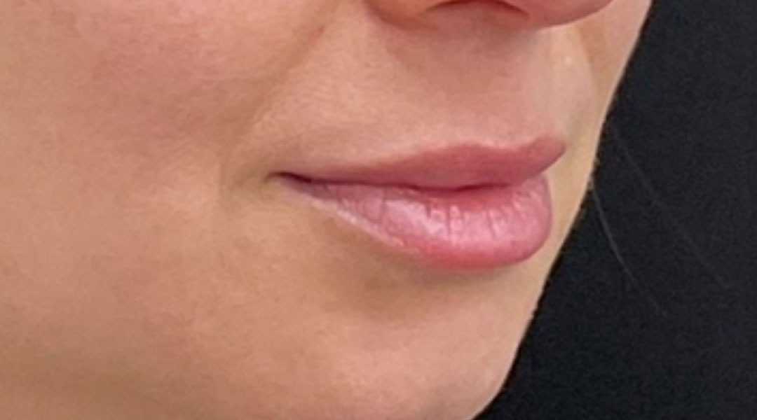 Aesthetics Skin Treatments Thread lift Tulsa