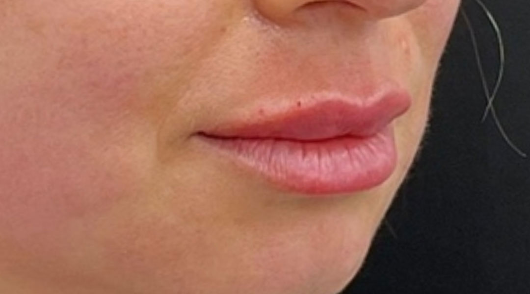 Aesthetics Skin Treatments Thread lift Tulsa