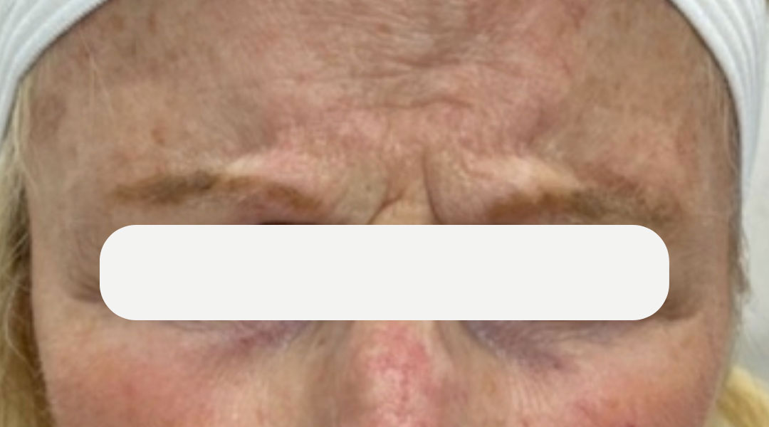 Aesthetics Skin Treatments Thread lift Tulsa