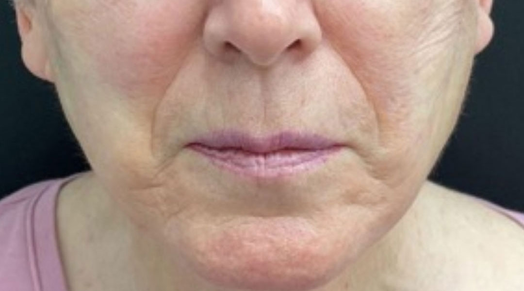 Aesthetics Skin Treatments Thread lift Tulsa